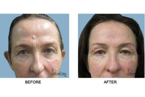 Face brow lift image