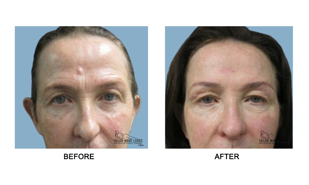 Face brow lift image