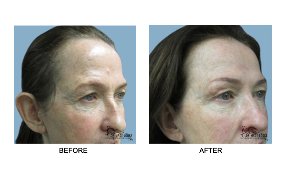 Face brow lift image