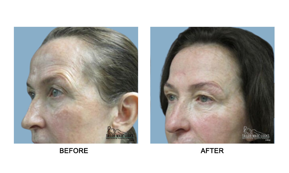 Face brow lift image