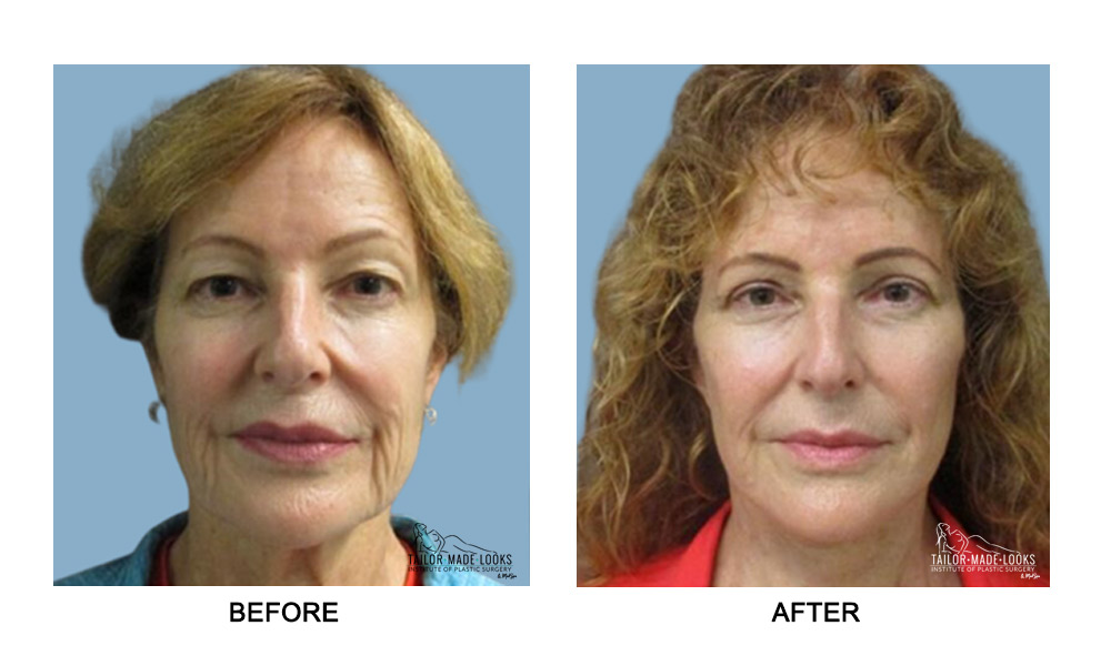 Fcae surgery images