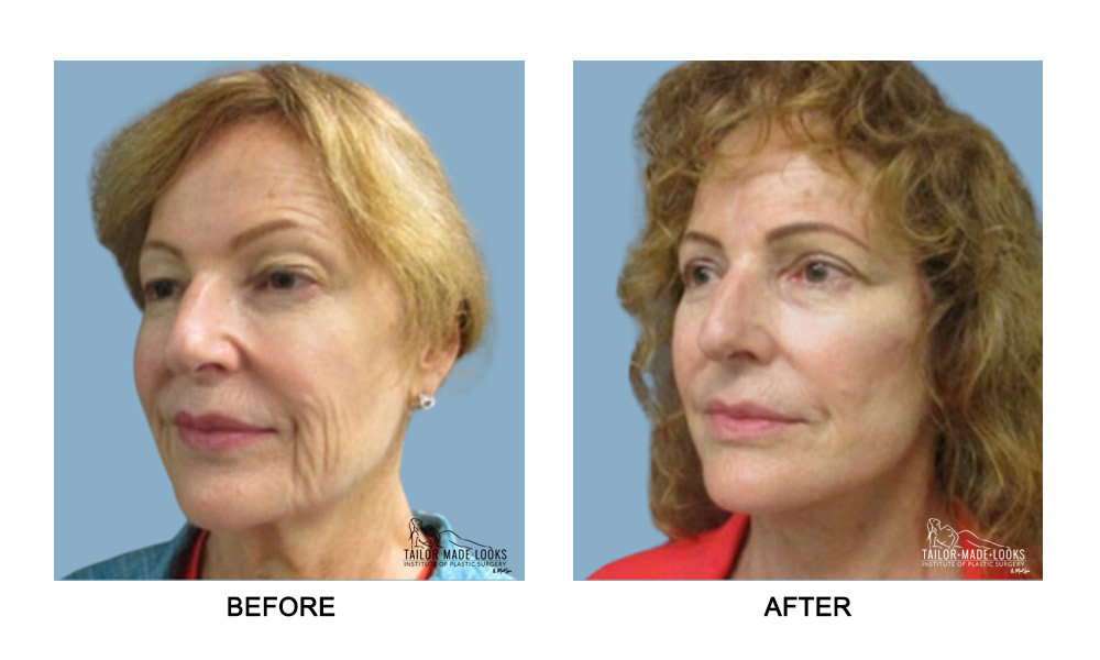 Fcae surgery images