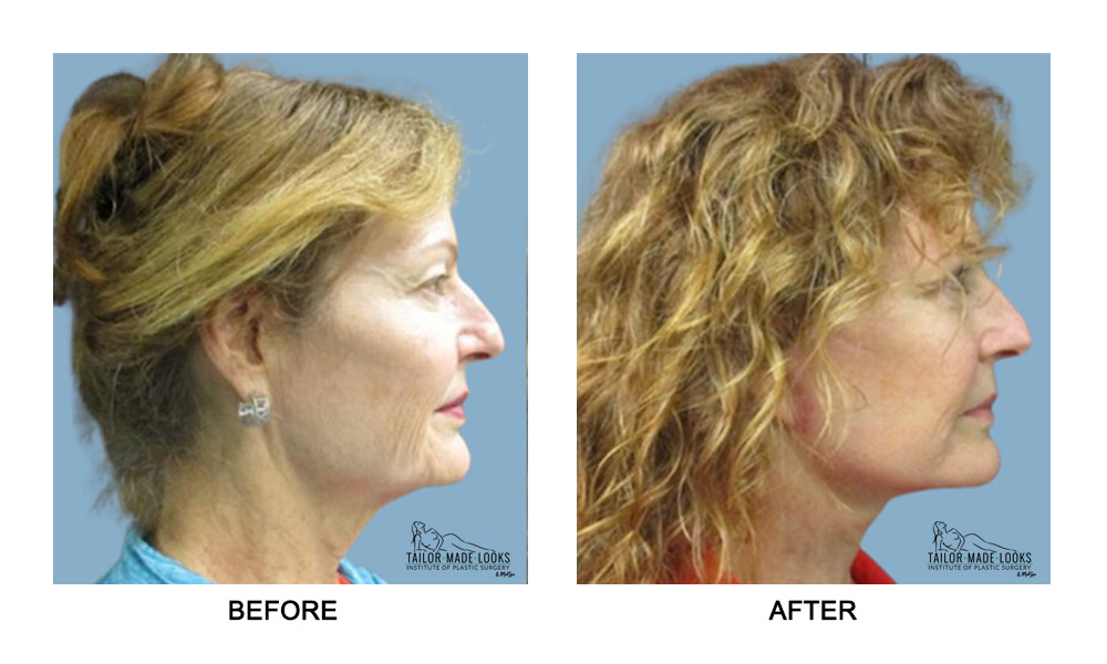 Fcae surgery images