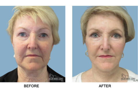 Face surgery images