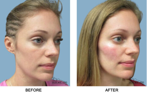 Face filler treatment
