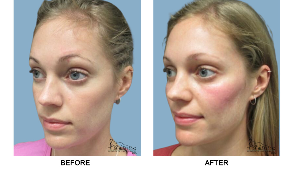 Face filler treatment