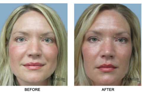 Face filler treatment