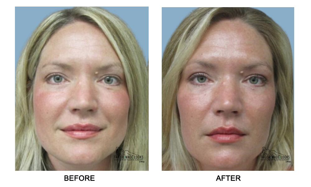 Face filler treatment