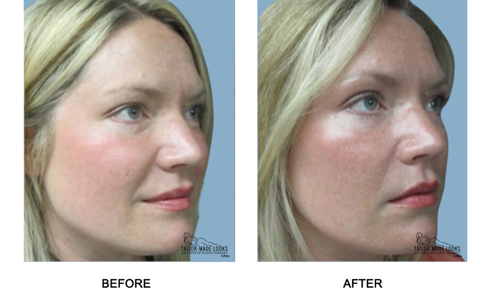 Face filler treatment