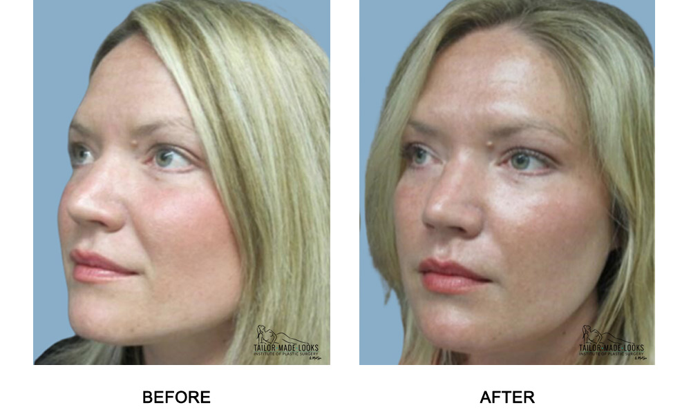 Face filler treatment