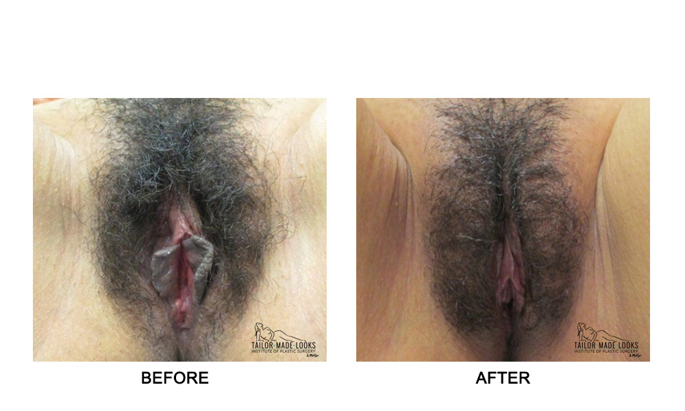 Labiaplasty