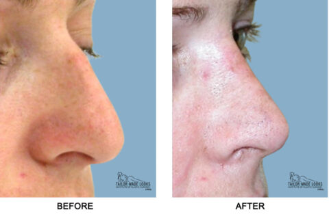 Nose Rhinoplasty