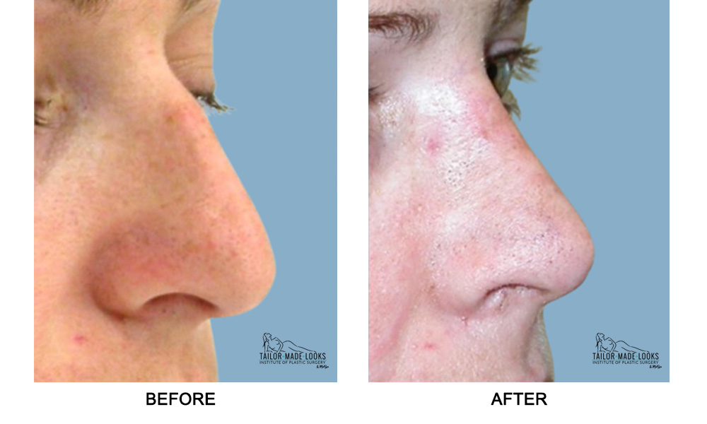 Nose Rhinoplasty