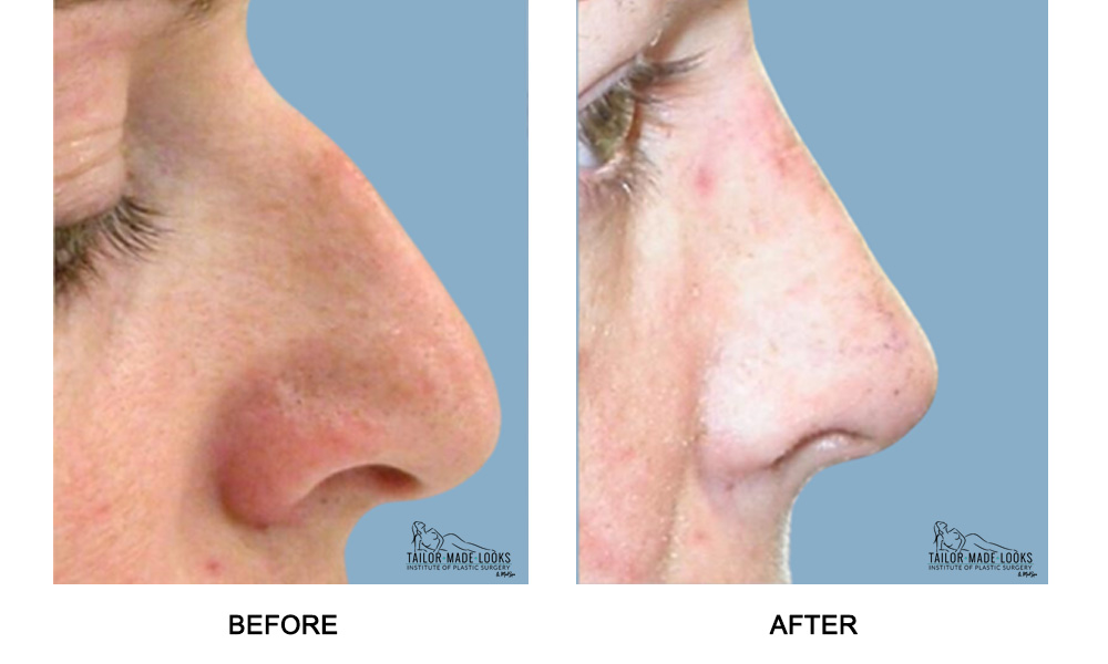 Nose Rhinoplasty