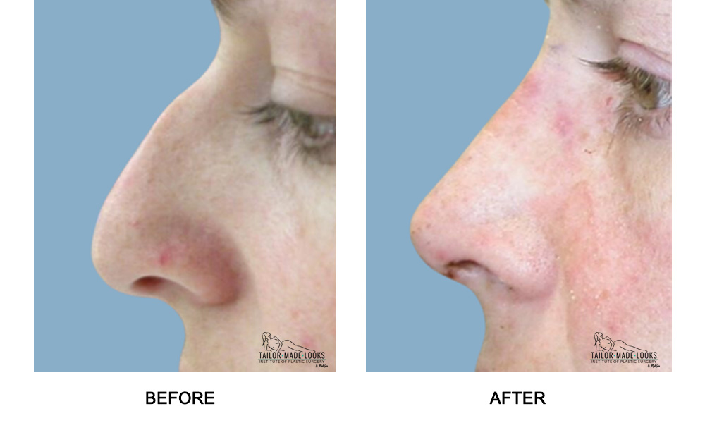 Nose Rhinoplasty