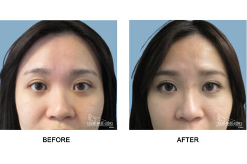 Nose Rhinoplasty