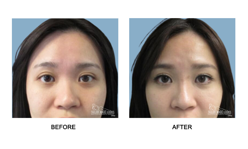 Nose Rhinoplasty