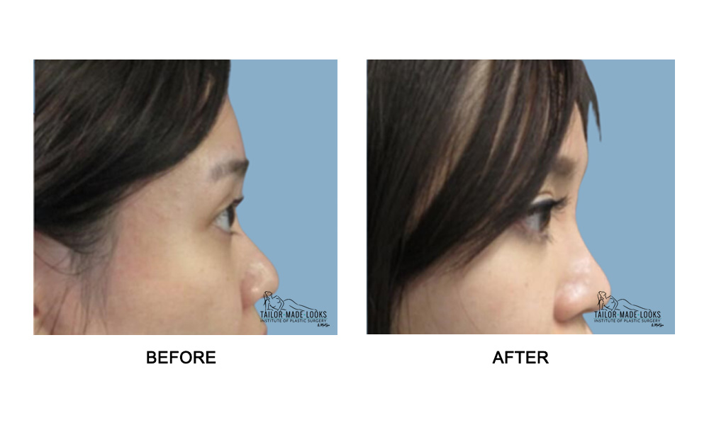 Nose Rhinoplasty