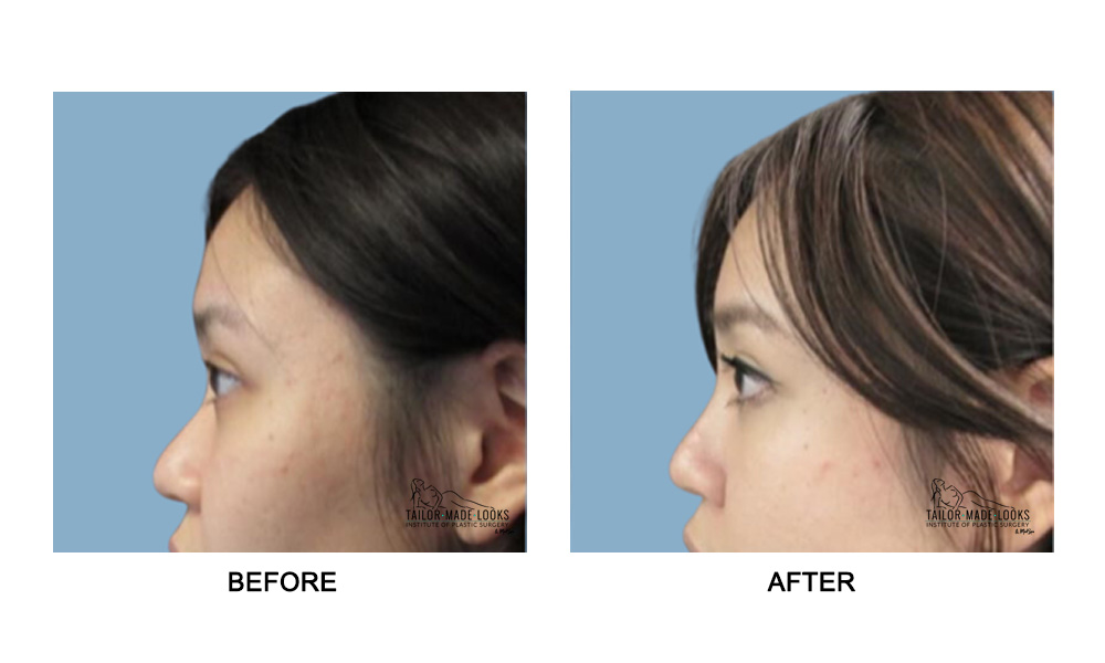 Nose Rhinoplasty