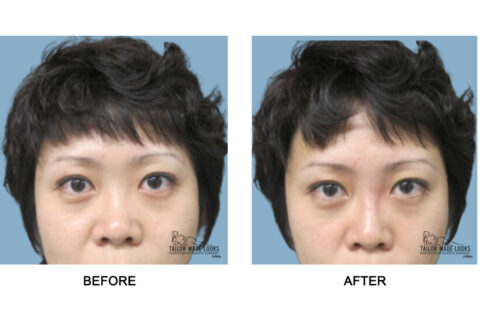 Nose Rhinoplasty