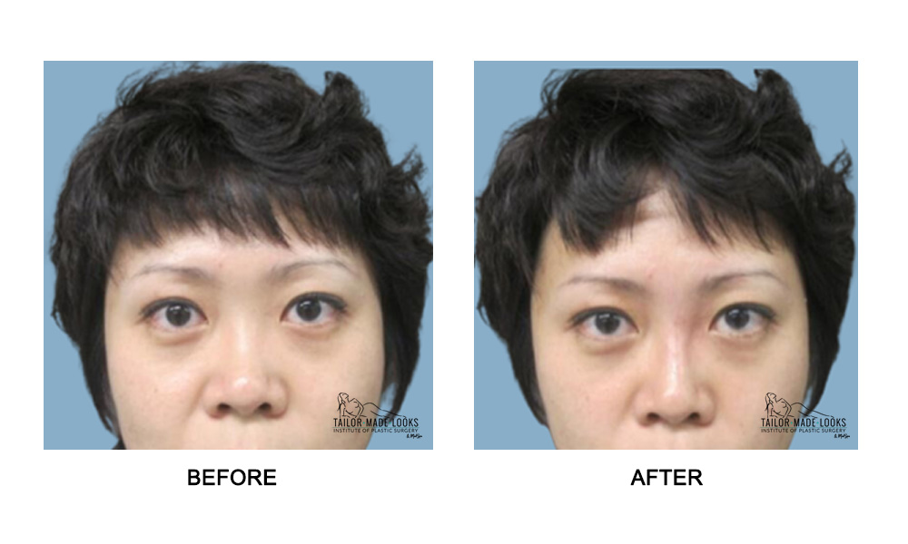 Nose Rhinoplasty