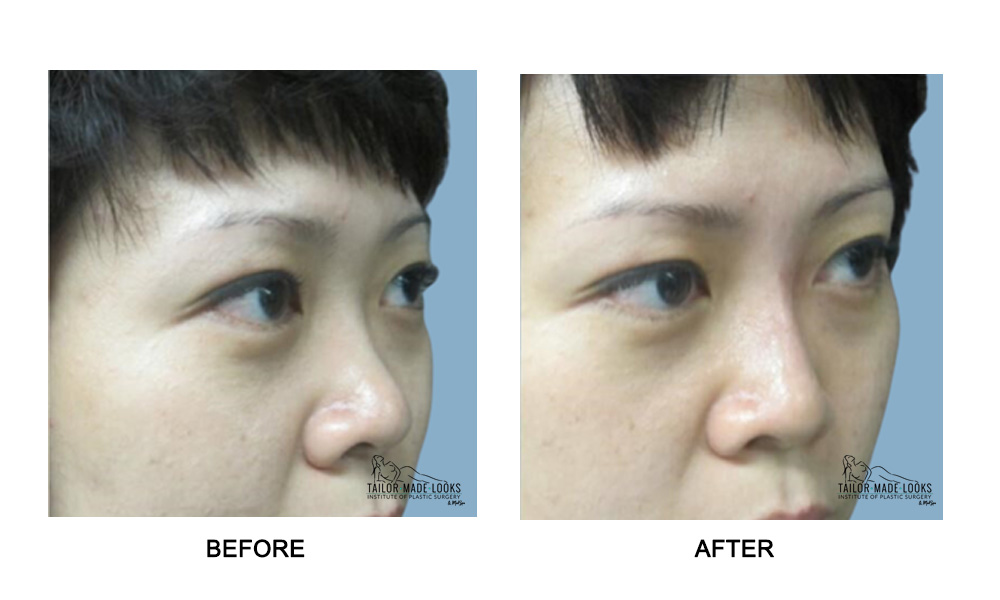 Nose Rhinoplasty