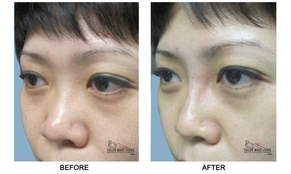 Nose Rhinoplasty