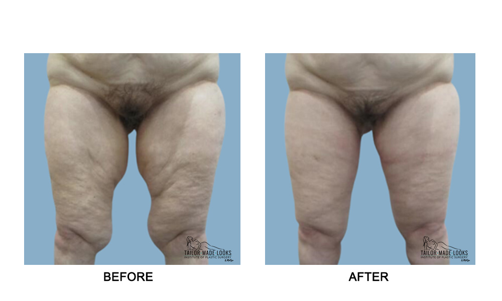 Thigh Lift Surgery Image