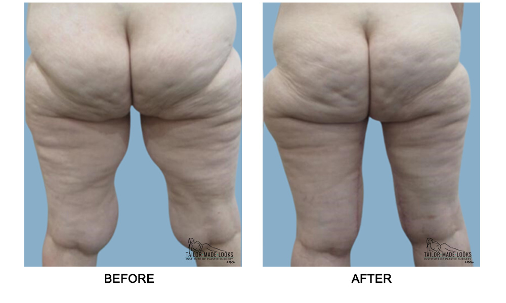 Thigh Lift Surgery Image