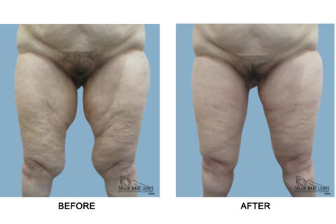 Thigh Lift Surgery Image