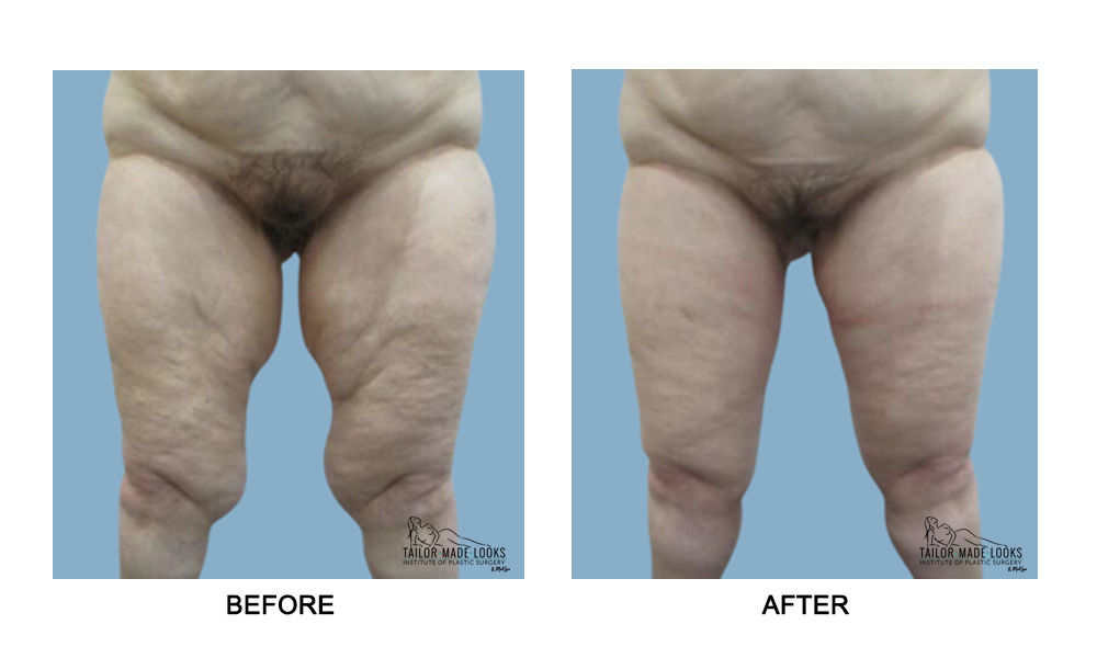 Thigh Lift Surgery Image