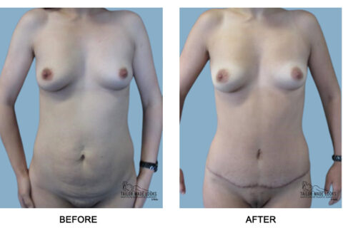 Tummy Tuck