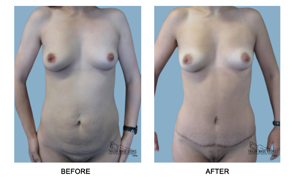 Tummy Tuck