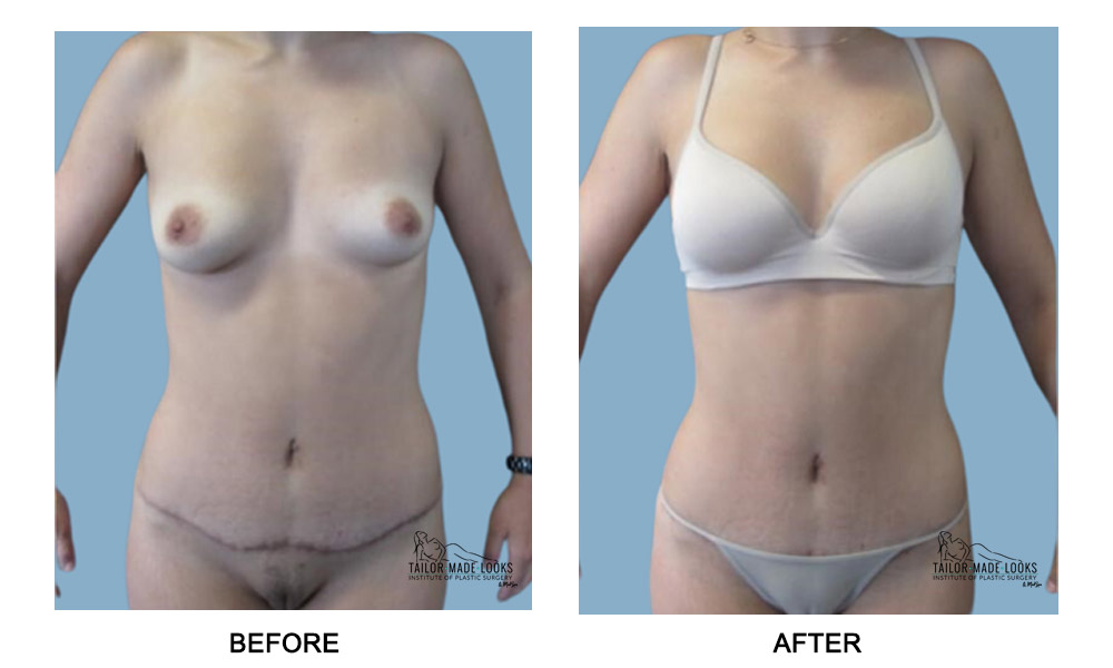 Tummy Tuck