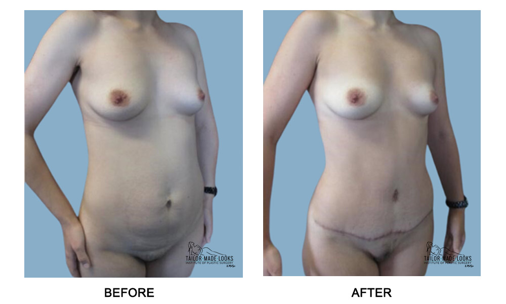 Tummy Tuck