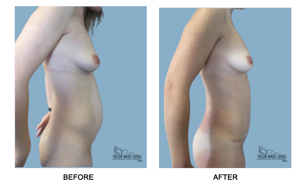 Tummy Tuck