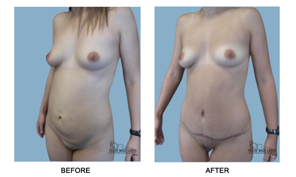 Tummy Tuck