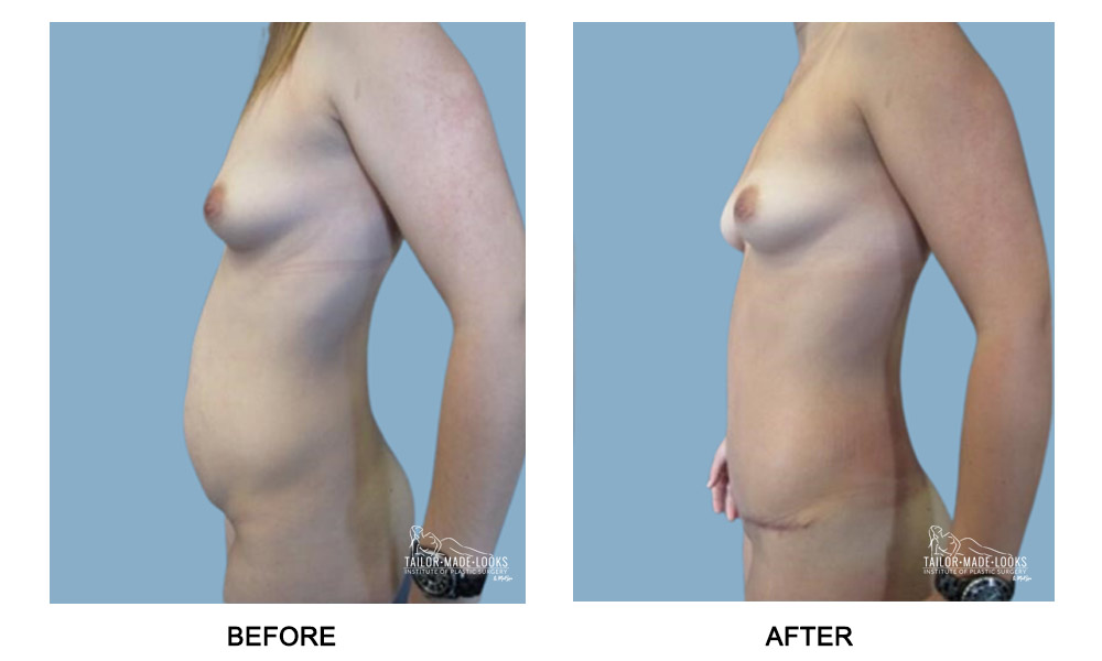 Tummy Tuck