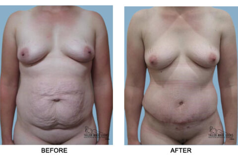 Tummy tuck