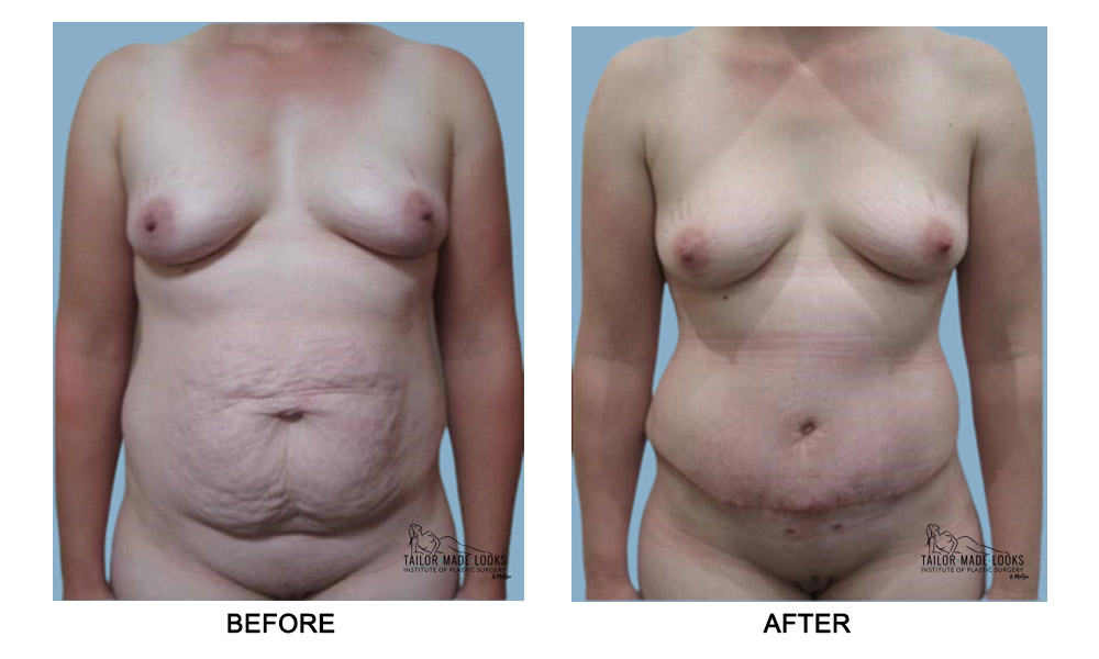 Tummy tuck