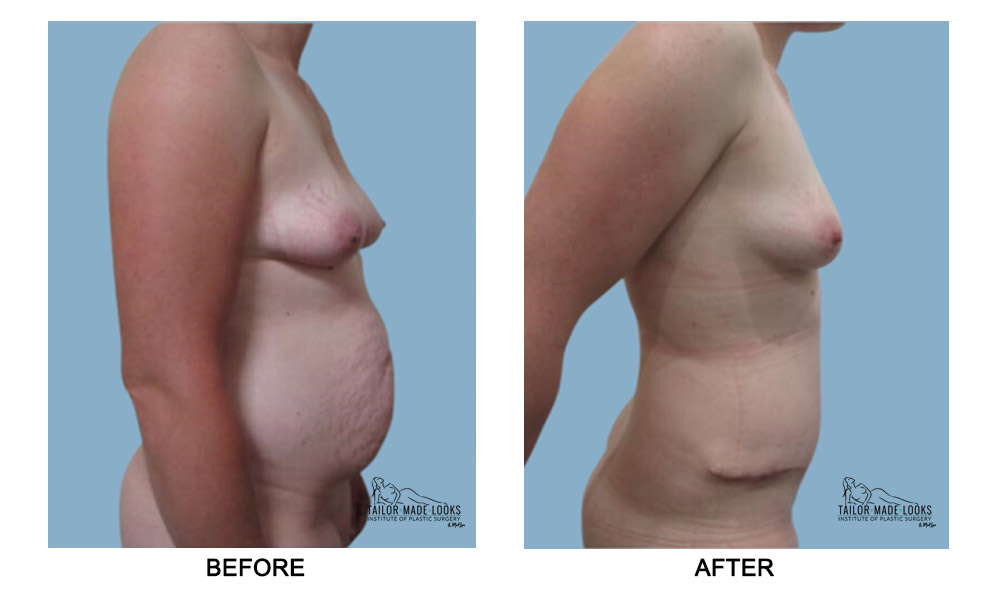 Tummy tuck