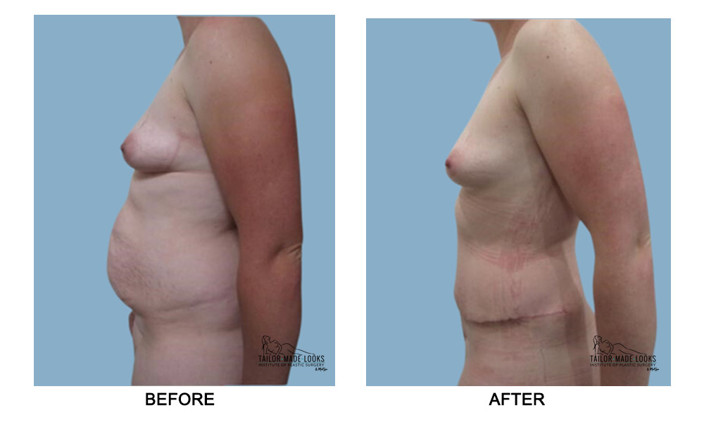 Tummy tuck