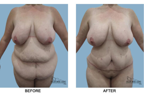 Tummy tuck