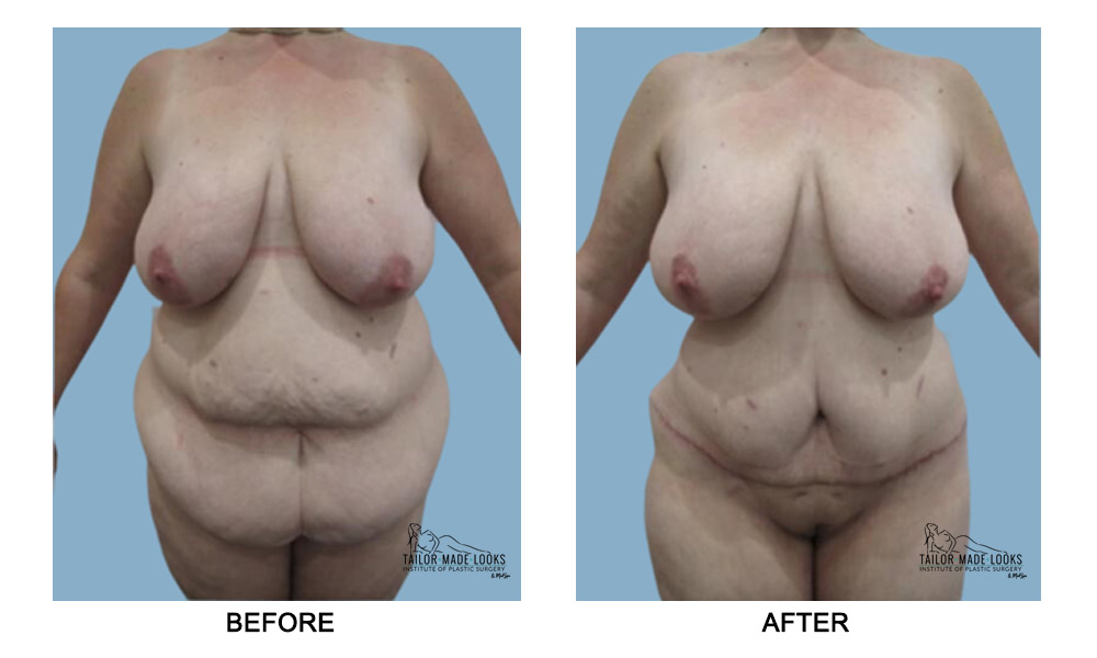 Tummy tuck