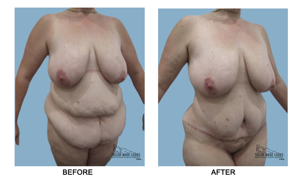 Tummy tuck