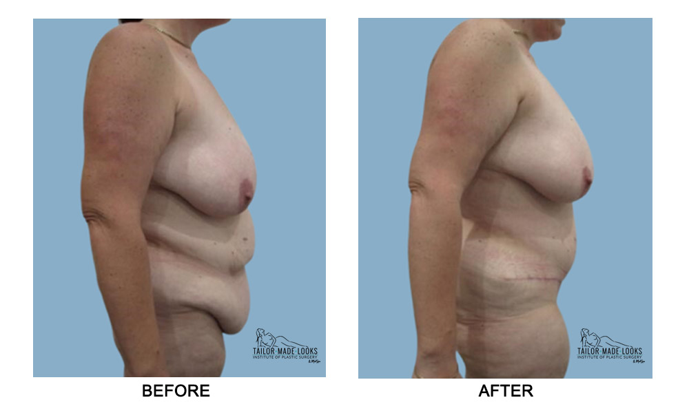 Tummy tuck