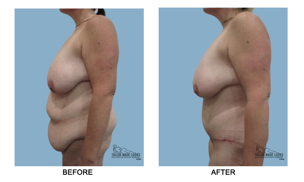 Tummy tuck