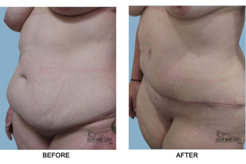 Tummy tuck