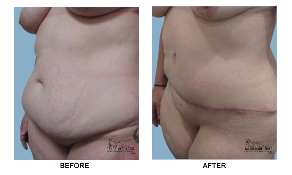 Tummy tuck