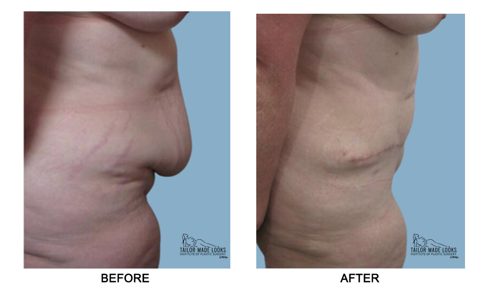 Tummy tuck